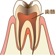 歯髄炎