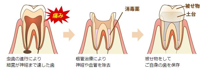 根管治療の概要