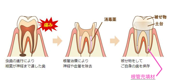 根管充填材